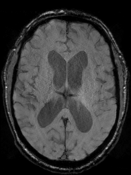 Acoustic schwannoma (Radiopaedia 55729-62281 Axial SWI 29).png