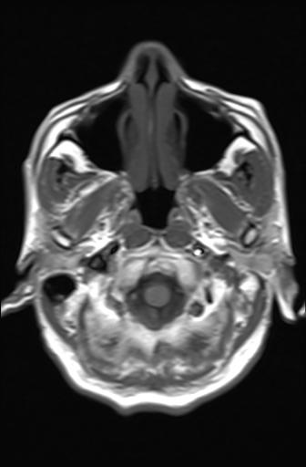 File:Acoustic schwannoma - probable (Radiopaedia 20386-20292 Axial T1 2).jpg