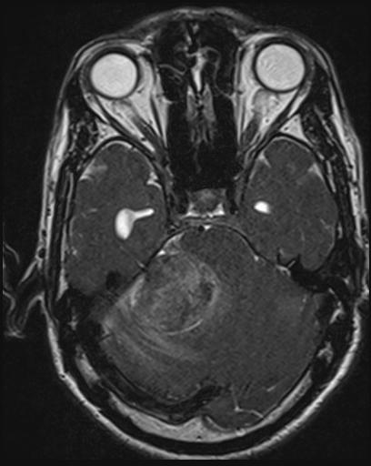 Acoustic schwannoma - probable (Radiopaedia 20386-20292 Axial T1 47).jpg