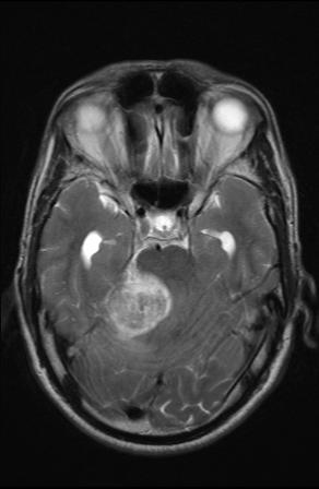 File:Acoustic schwannoma - probable (Radiopaedia 20386-20292 Axial T2 7).jpg