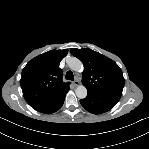 File:Acquired tracheoesophageal fistula (Radiopaedia 57747-65042 Axial C+ portal venous phase 32).jpg