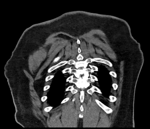 Acromioclavicular joint cyst (Radiopaedia 58455-65610 Coronal C+ arterial phase 126).jpg