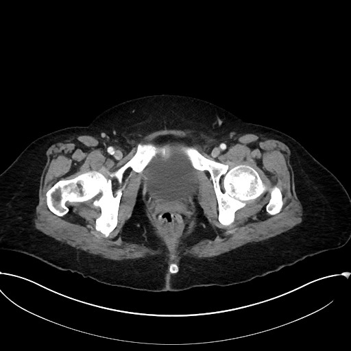 Active Crohn disease (Radiopaedia 59394-66750 Axial C+ portal venous phase 70).jpg