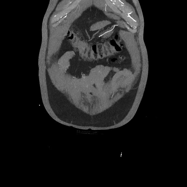 Active colonic bleed on CT (Radiopaedia 49765-55025 Coronal art MIP 12).jpg