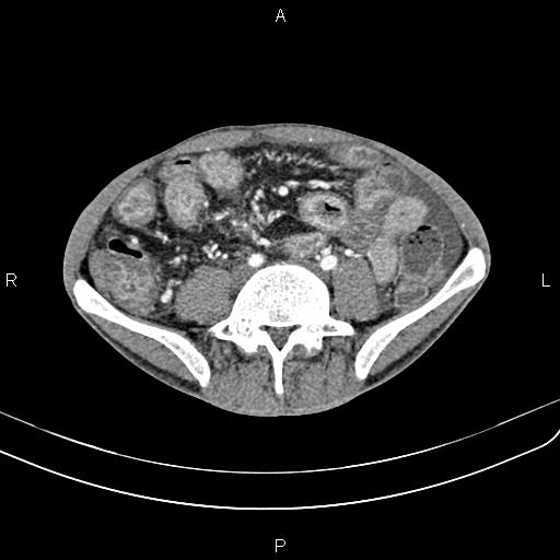 File:Active crohn disease (Radiopaedia 87133-103397 Axial C+ arterial phase 67).jpg