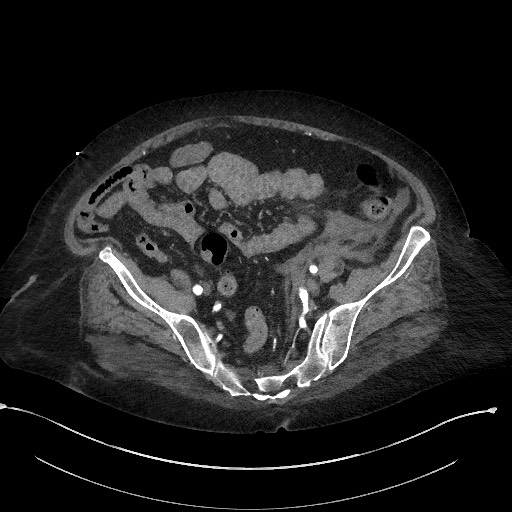 Active renal extravasation with large subcapsular and retroperitoneal hemorrhage (Radiopaedia 60975-68796 Axial C+ arterial phase 149).jpg