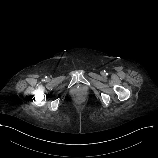 File:Active renal extravasation with large subcapsular and retroperitoneal hemorrhage (Radiopaedia 60975-68796 Axial C+ arterial phase 203).jpg