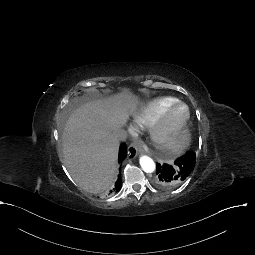 File:Active renal extravasation with large subcapsular and retroperitoneal hemorrhage (Radiopaedia 60975-68796 Axial C+ arterial phase 28).jpg