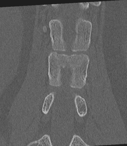 Acute L1 burst compression fracture (Radiopaedia 34430-35755 Coronal bone window 35).png