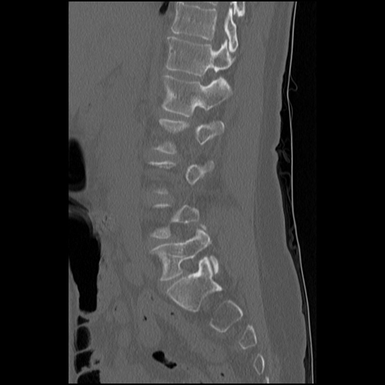 Acute Schmorl's node (Radiopaedia 83276-102365 Sagittal bone window 49).jpg