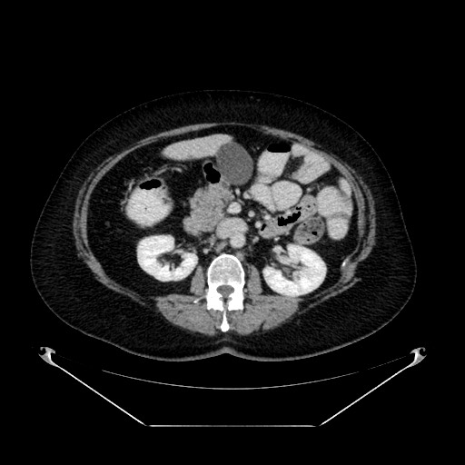 File:Acute appendicitis, heterotaxy syndrome (Radiopaedia 66884-76202 Axial 49).jpg