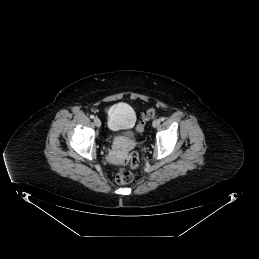 Acute appendicitis, heterotaxy syndrome (Radiopaedia 66884-76202 Axial C+ portal venous phase 116).jpg