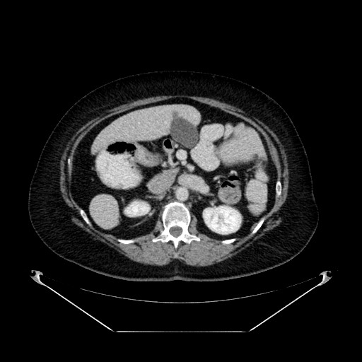 Acute appendicitis, heterotaxy syndrome (Radiopaedia 66884-76202 Axial C+ portal venous phase 45).jpg
