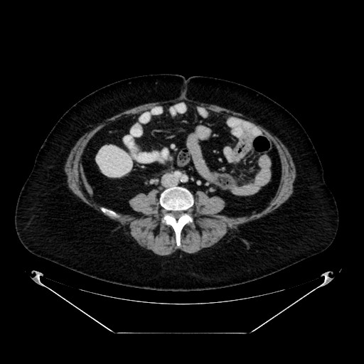 Acute appendicitis, heterotaxy syndrome (Radiopaedia 66884-76202 Axial C+ portal venous phase 77).jpg