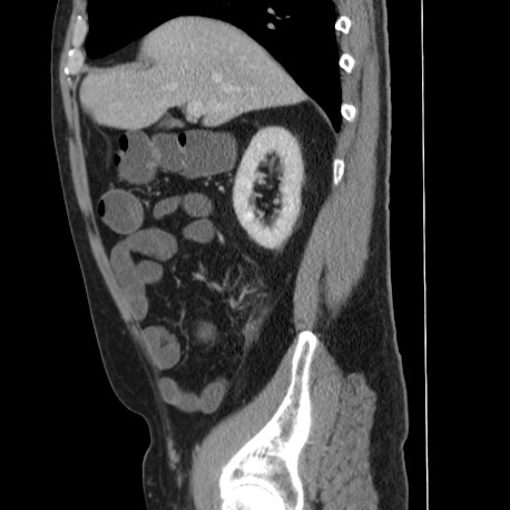 Acute appendicitis (Radiopaedia 66513-75790 Sagittal C+ portal venous phase 46).jpg