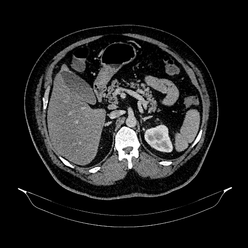 File:Acute appendicitis (Radiopaedia 79950-93224 Axial C+ portal venous phase 35).jpg