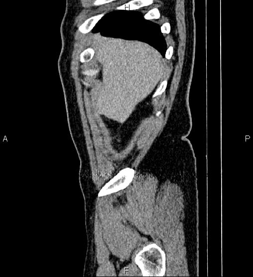 File:Acute appendicitis (Radiopaedia 84780-100240 Sagittal C+ portal venous phase 7).jpg