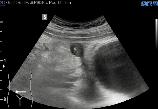 File:Acute appendicitis (Radiopaedia 85193-100745 B 117).jpg