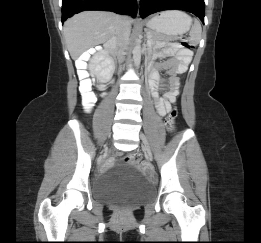 File:Acute appendicitis (Radiopaedia 9417-10099 Coronal C+ portal venous phase 3).jpg