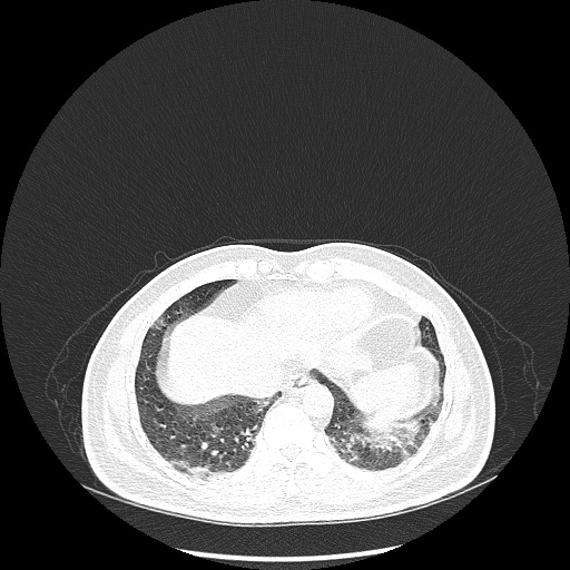 Acute appendicitis and COVID 19 pneumonia (Radiopaedia 76604-88380 Axial lung window 44).jpg
