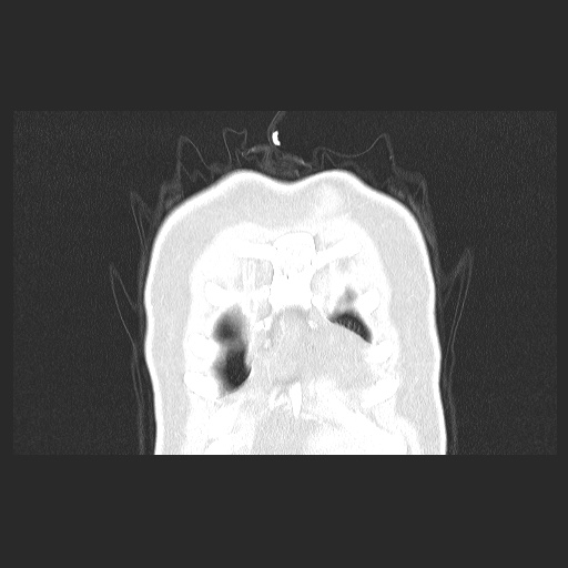 File:Acute appendicitis and COVID 19 pneumonia (Radiopaedia 76604-88380 G 8).jpg