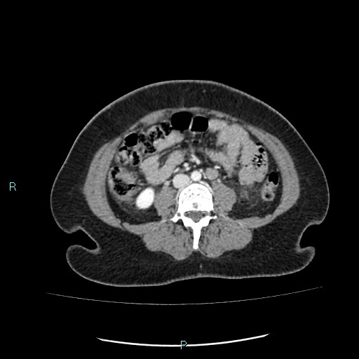 Acute bilateral pyelonephritis (Radiopaedia 37146-38881 Axial C+ portal venous phase 59).jpg