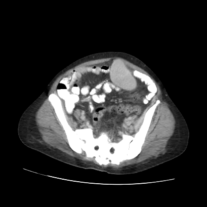 File:Acute calculous cholecystitis in patient with osteopetrosis (Radiopaedia 77871-90159 Axial C+ portal venous phase 63).jpg