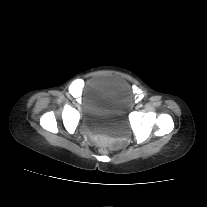 File:Acute calculous cholecystitis in patient with osteopetrosis (Radiopaedia 77871-90159 Axial C+ portal venous phase 72).jpg