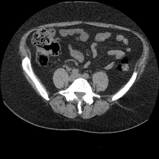 File:Acute cholecystitis and ureteric colic (Radiopaedia 42330-45444 Axial prone 67).jpg