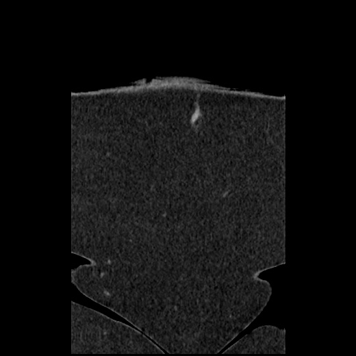 File:Acute cholecystitis and ureteric colic (Radiopaedia 42330-45444 Coronal prone 12).jpg