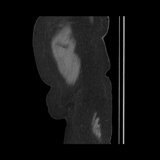 Acute cholecystitis with tensile fundus sign (Radiopaedia 71394-81723 Sagittal non-contrast 154).jpg