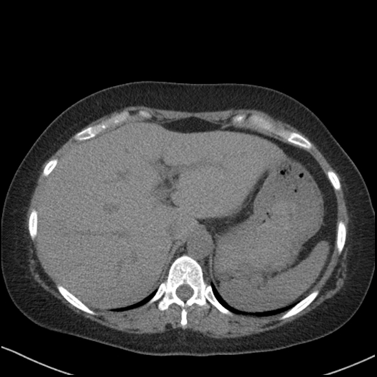 Acute colonic hemorrhage in ulcerative colitis (Radiopaedia 77415-89538 Axial non-contrast 25).jpg