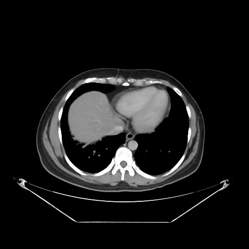 File:Acute complicated calculous cholecystitis (Radiopaedia 55202-61587 Axial C+ delayed 18).jpg