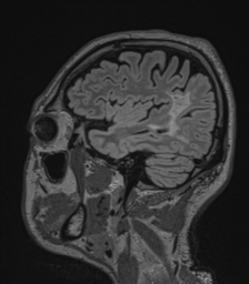 File:Acute disseminated encephalomyelitis (ADEM)- Anti-NMDA receptor encephalitis (Radiopaedia 54920-61201 Sagittal FLAIR 63).png
