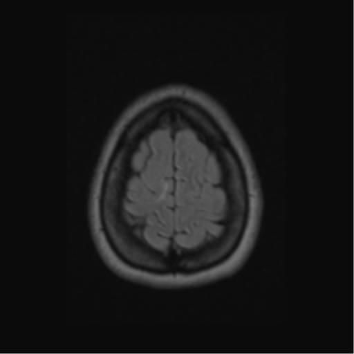 Acute disseminated encephalomyelitis (ADEM) (Radiopaedia 38073-40065 Axial FLAIR 60).png