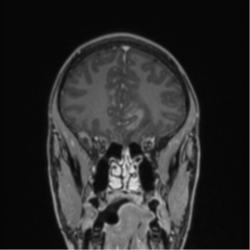 File:Acute disseminated encephalomyelitis (ADEM) (Radiopaedia 65319-74349 Coronal T1 C+ 45).png