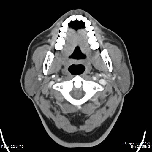 File:Acute epiglottitis (Radiopaedia 54375-60590 Axial 33).jpg