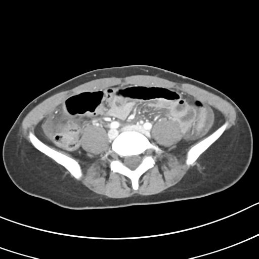 Acute gangrenous appendicitis with perforation (Radiopaedia 40152-42662 Axial C+ portal venous phase 46).png