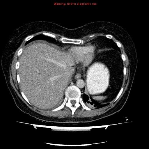 File:Acute gangrenous cholecystitis (Radiopaedia 10123-10661 Axial C+ portal venous phase 14).jpg