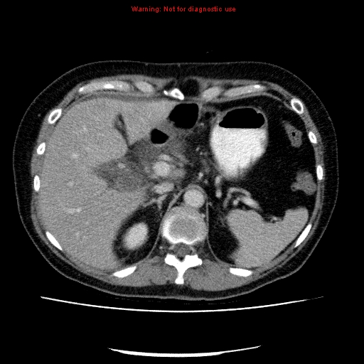 Acute gangrenous cholecystitis (Radiopaedia 10123-10661 Axial C+ portal venous phase 26).jpg