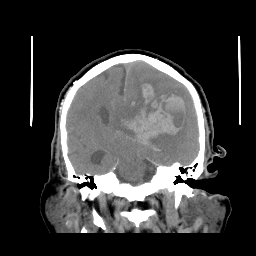 Acute hemorrhagic stroke (Radiopaedia 17507-17223 Coronal non-contrast 29).jpg