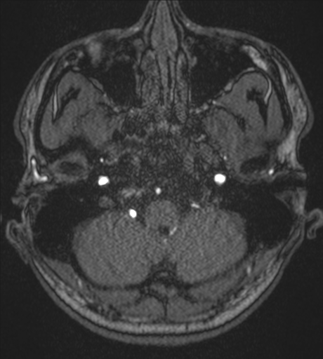 Acute left middle cerebral artery territory infarct with clot retrieval (Radiopaedia 47732-52433 Axial MRA 8).png