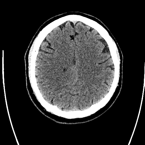 Acute left middle cerebral artery territory ischemic stroke (Radiopaedia 35688-37223 Axial non-contrast 56).png
