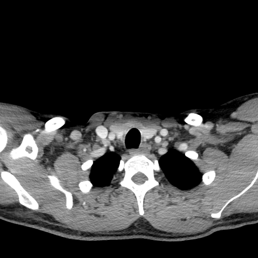 Acute longus colli calcific tendinitis (Radiopaedia 72495-83036 Axial C+ arterial phase 79).jpg