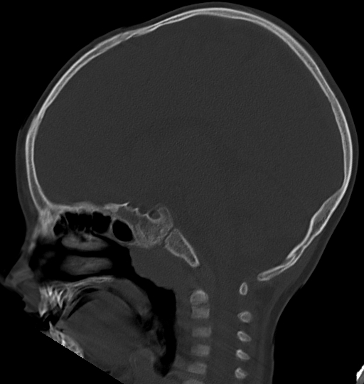File:Acute mastoiditis (Radiopaedia 82678-96881 Sagittal bone window 30).jpg