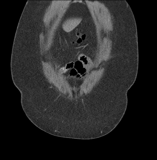 Acute mesenteric venous ischemia (Radiopaedia 46041-50383 Coronal C+ portal venous phase 12).jpg