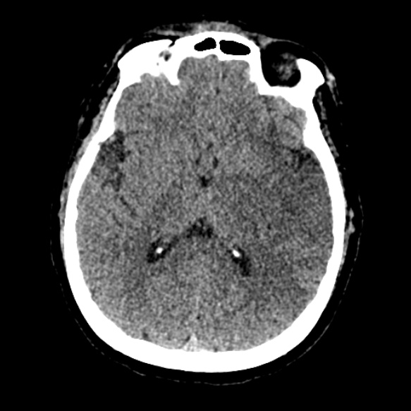 Acute middle cerebral artery territory infarct (Radiopaedia 52380-58283 Axial non-contrast 54).jpg