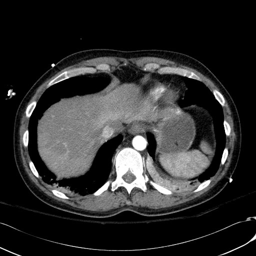 File:Acute myocardial infarction in CT (Radiopaedia 39947-42415 Axial C+ arterial phase 119).jpg