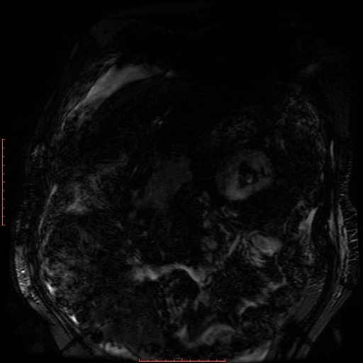 File:Acute necrotizing pancreatitis (Radiopaedia 28194-28448 Coronal MRCP 86).jpg