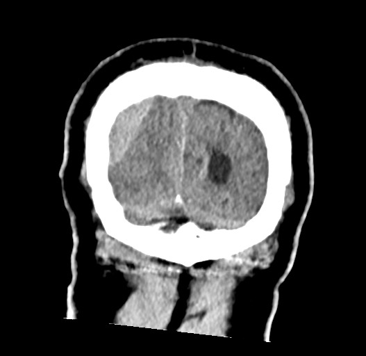 Acute on chronic subdural hematoma (Radiopaedia 78346-90966 Coronal non-contrast 60).jpg